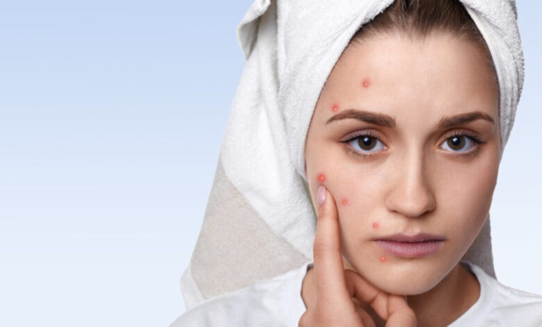 Simple Home Remedies to Reduce Pimples Overnight and Soothe Skin Naturally