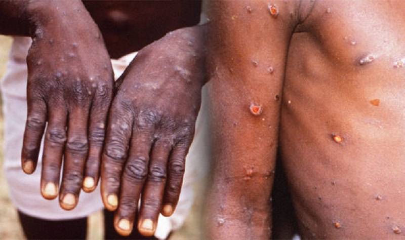 Monkeypox cases rise in India, third case confirmed in Kerala