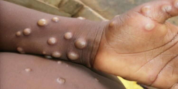 Monkeypox in India: 1st case found in Kerala, Centre rushes high-level team