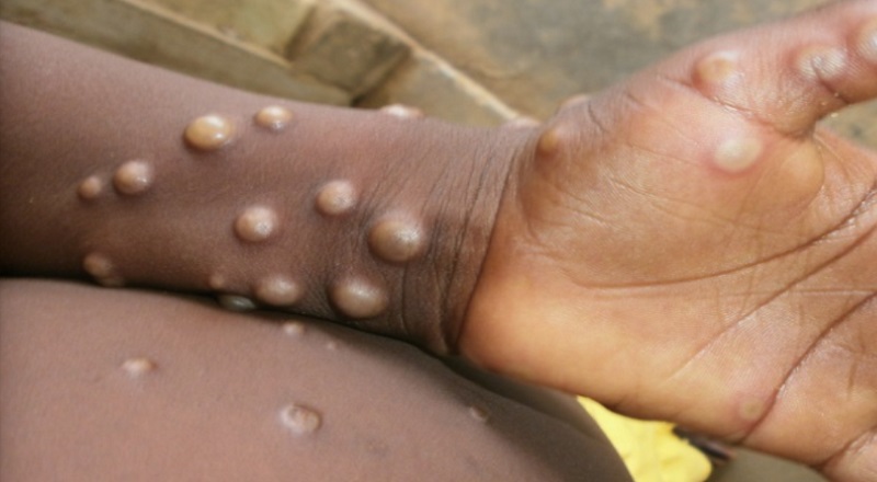 Monkeypox in India: 1st case found in Kerala, Centre rushes high-level team