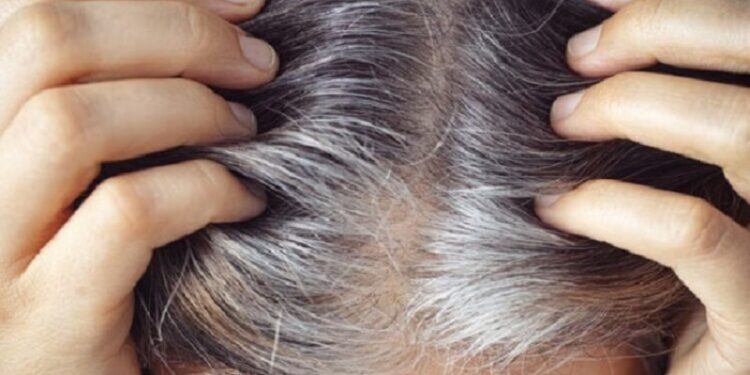 White hair tension! here is good homemade remedies