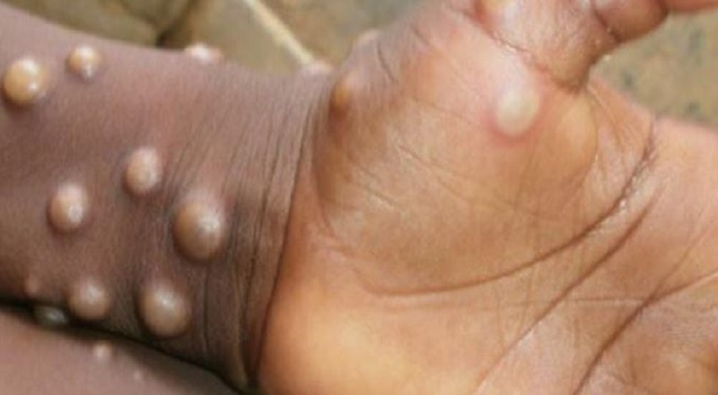 Monkeypox: Kerala confirms India's first death