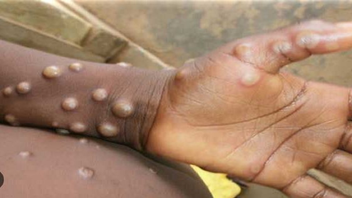 High Alert declared: Monkeypox infection found in two persons in Kerala