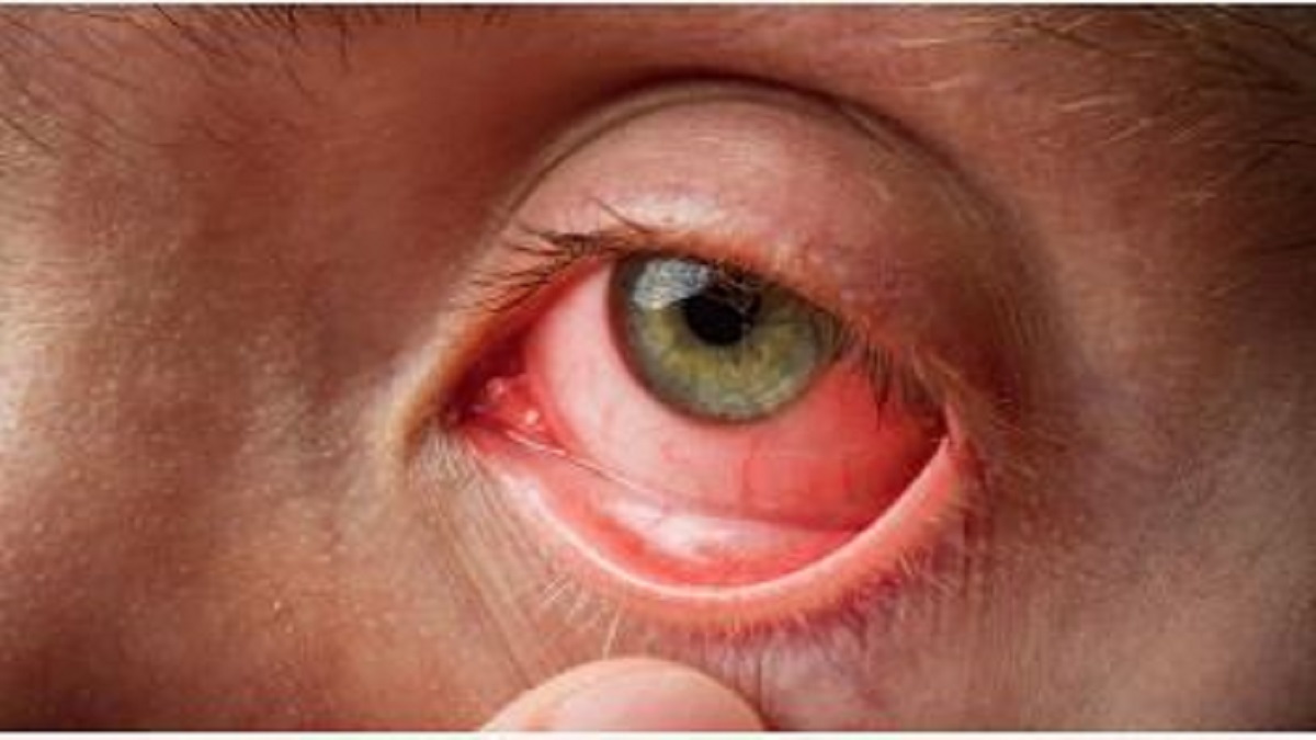 Madras Eye Cases surge in Karnataka: Symptoms, prevention method and treatment