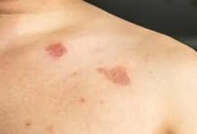 Natural Remedy for Ringworm and Itchy Skin Infections Using Simple Home Ingredients