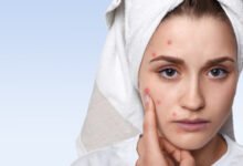 Simple Home Remedies to Reduce Pimples Overnight and Soothe Skin Naturally
