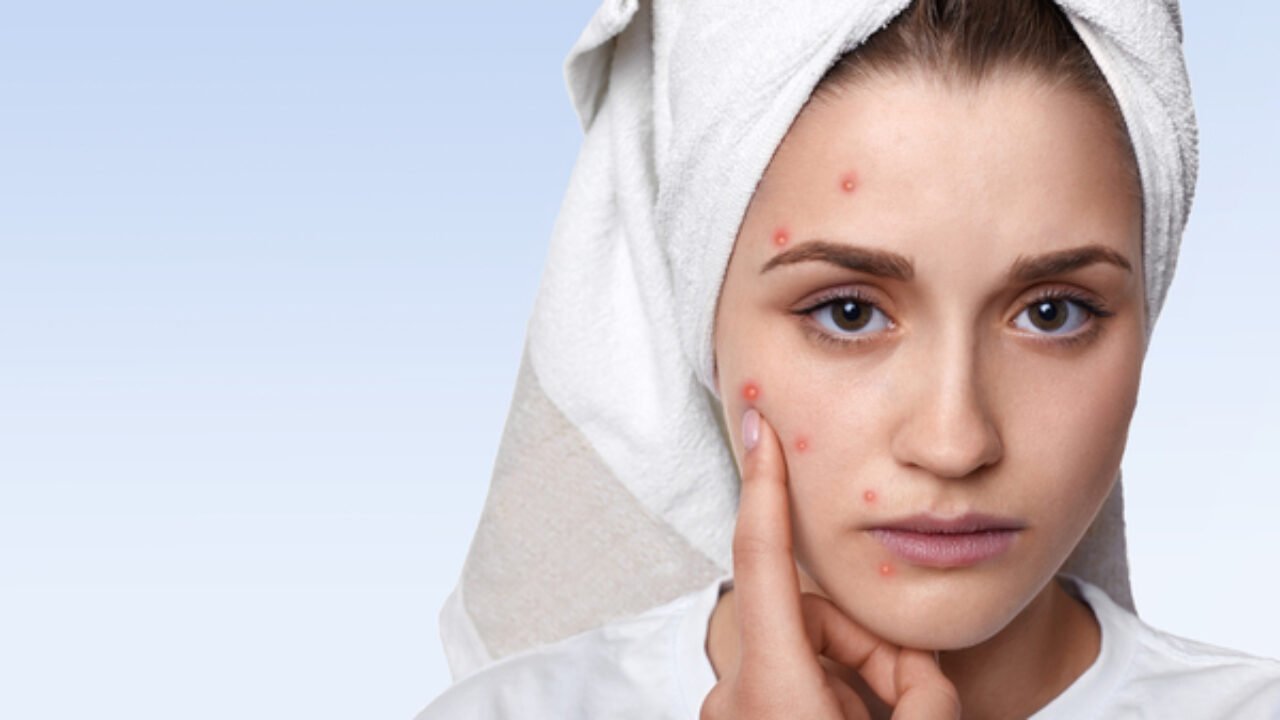 Simple Home Remedies to Reduce Pimples Overnight and Soothe Skin Naturally