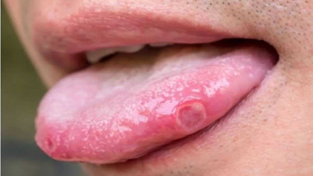 Mouth Ulcers: Avoid these 5 foods if you have symptoms